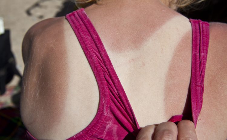  Sunburn and Cycling: the Dos and Don’ts